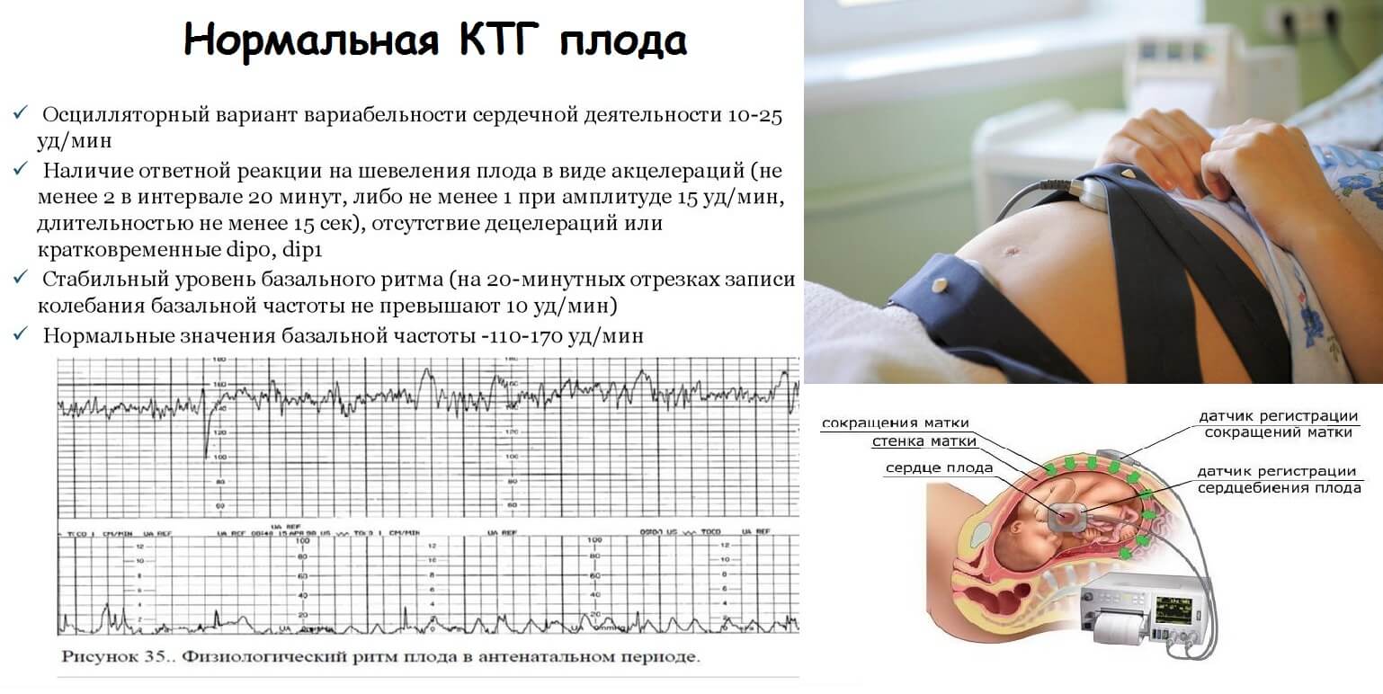 КТГ при беременности порядок проведения